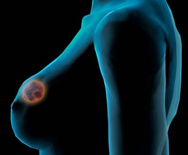 Sistema eletrnico detecta precocemente cncer de mama