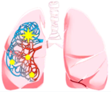 DNA de leso pr-maligna de pulmo pode ser detectado no sangue